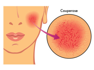 couperose