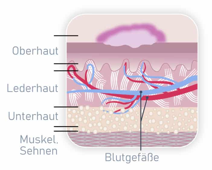 Atrophie Narbe, Narben, Narbenpflege