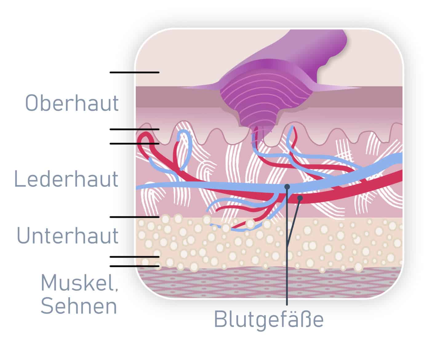 Narbenpflege, Narbe, Narbenkeloid