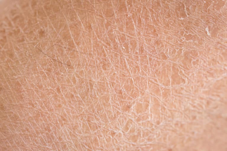 ichthyosis, Urea, almond oil